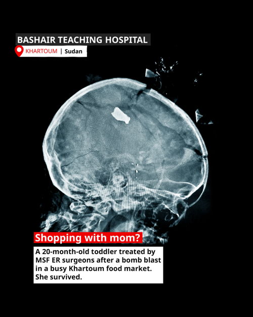  While shopping with her mother at a nearby market this 20-month-old toddler was struck by shrapnel after a bomb-blast tore through the neighbourhood.Copyright: MSF 