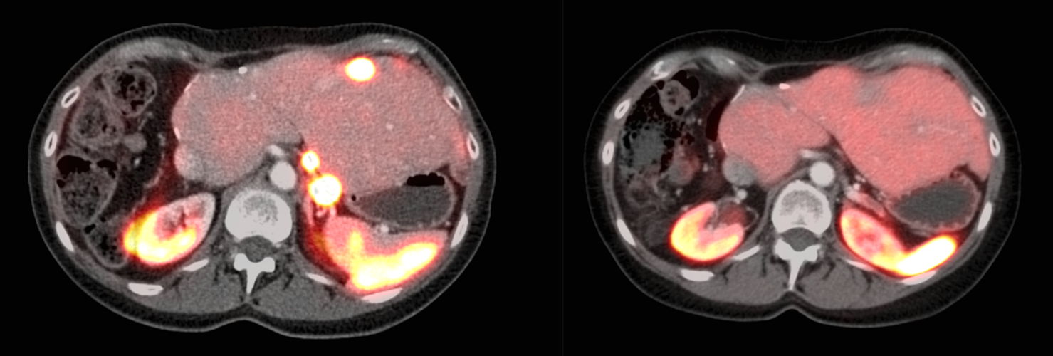 Voor therapie toont deze PET/CT-scan uitzaaiingen in en achter de lever (fel oplichtende puntjes) die het diagnostisch middel in zeer hoge mate opnamen. Na therapie met het lutetium-177 bevattend geneesmiddel zijn de uitzaaiingen niet meer detecteerbaar. 