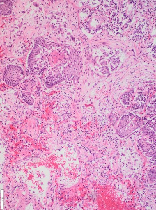 Lung tissue with scarring, bleeds and signs of a clean-up following a severe COVID infection. Credits Prof. Jo Van Dorpe and Prof. Amélie Dendooven, Pathologic Anatomy, Ghent Universitary Hospital.