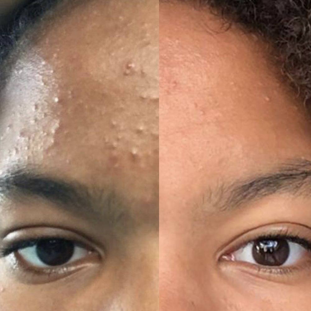 Avant et après le traitement