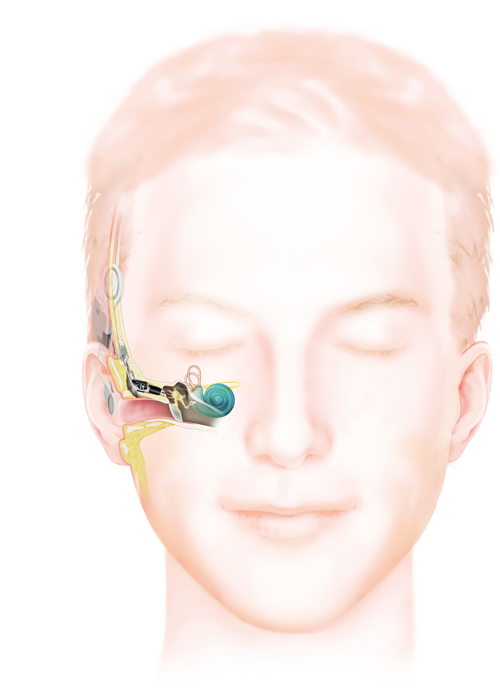 Afbeeldingen eigendom van Cochlear Limited, © 2019. 