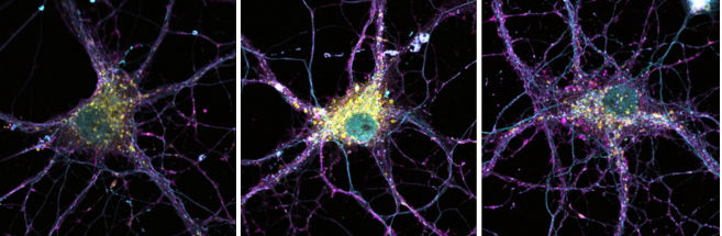 Hippocampal neurons with staining for endosomes (turquoise and purple) and lysosomes (yellow). When the PSEN2 gene is absent or carries a familial Alzheimer-related mutation (middle), the lysosomes become noticeably enlarged.