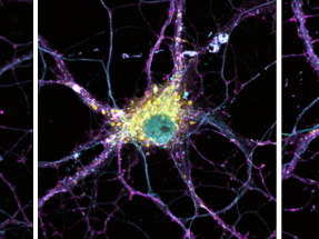 The genetic roots of rare mutations in Alzheimer’s disease