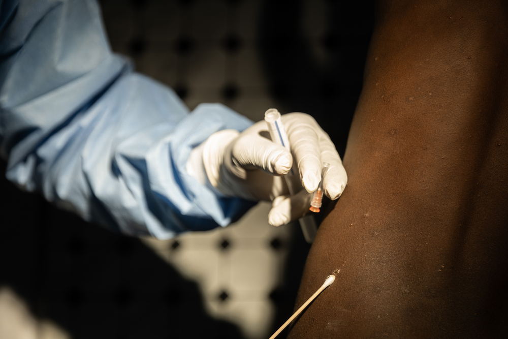 MSF doctor Richard Balegamire examines 10-year-old Baraka Faustin’s back during an mpox screening consultation in the isolation unit of the Kanyaruchinya displacement camp’s health centre, in the outskirts of Goma. This examination is part of the efforts MSF supports to detect cases early among people living in the displacement sites around Goma. Please note that the patients appearing in the pictures are screened for mpox by MSF – we cannot confirm if mpox was or was not confirmed Date taken: 28/08/2024 | Photographer: Michel Lunanga | Location: North Kivu 