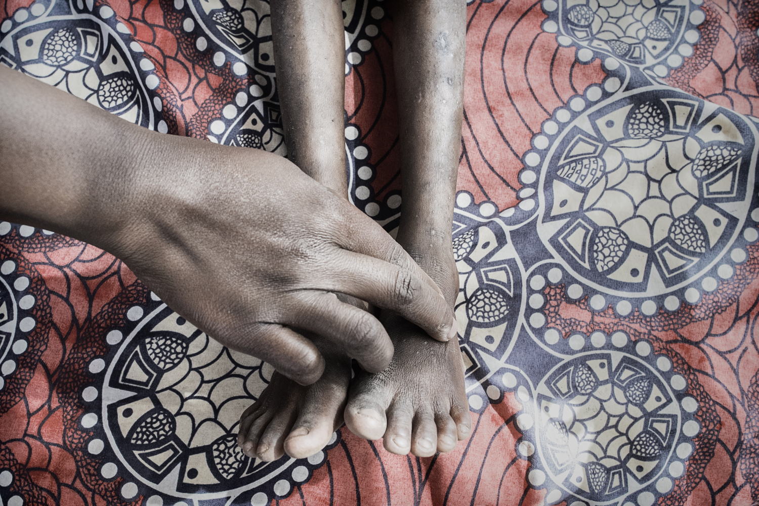 Une personne atteinte du VIH au Malawi © MSF