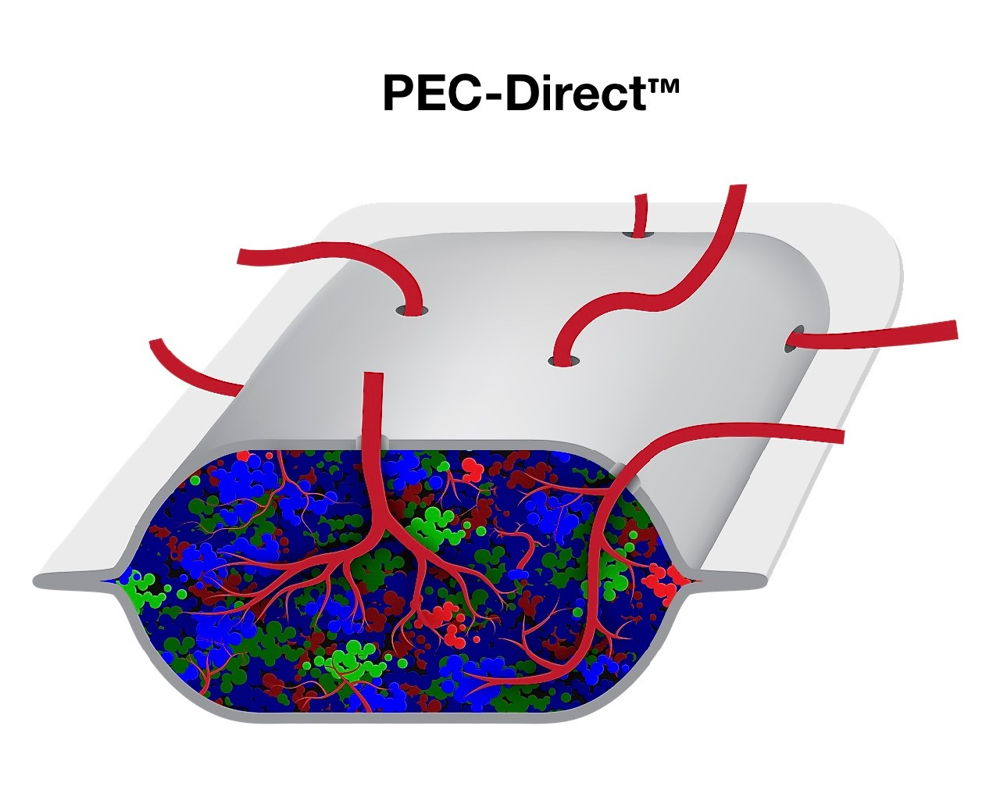 Implant of pancreatic progenitor cells encapsulated in device (ViaCyte PEC-Direct product) to become vascularized and to form endocrine cells with insulin-producing beta cells