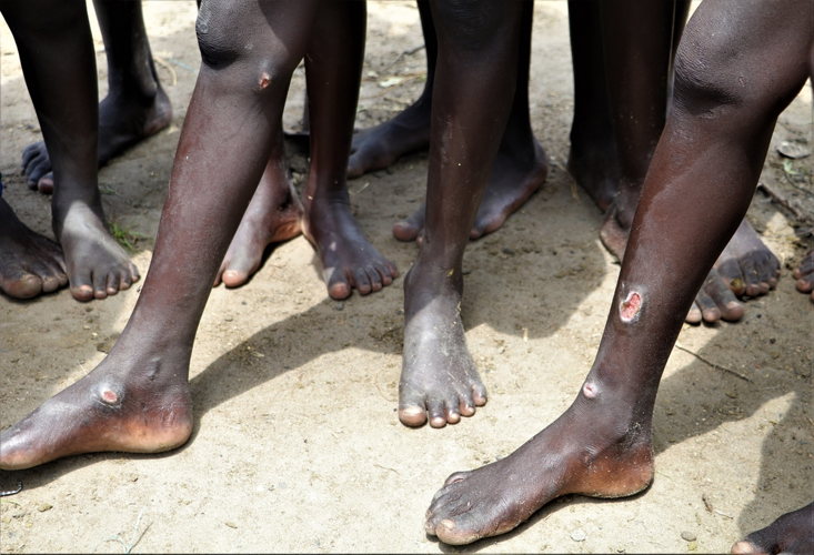 Children wait at MSF’s mobile clinic in Lanyeris, the Greater Pibor Administrative Area, South Sudan to receive treatment for their open wounds. After prolong walking in dirty flood waters many people suffer from waterborne diseases. This year’s floods are happening against the backdrop of multiple emergencies including COVID-19, increased violence and fighting, a growing economic crisis, and high levels of food insecurity. The needs for medical care are increasing with a sharp rise in malaria cases and fears of outbreaks of other diseases. Photographer: MSF/Tetiana Gaviuk Children wait at MSF’s mobile clinic in Lanyeris, the Greater Pibor Administrative Area, South Sudan to receive treatment for their open wounds. After prolong walking in dirty flood waters many people suffer from waterborne diseases. This year’s floods are happening against the backdrop of multiple emergencies including COVID-19, increased violence and fighting, a growing economic crisis, and high levels of food insecurity. The needs for medical care are increasing with a sharp rise in malaria cases and fears of outbreaks of other diseases. Photographer: MSF/Tetiana Gaviuk