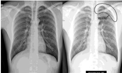 AI Proves Its Value in Assistance for Emergency Cases-- With Higher Accuracy and Timely Reporting Time of Chest Radiographs
