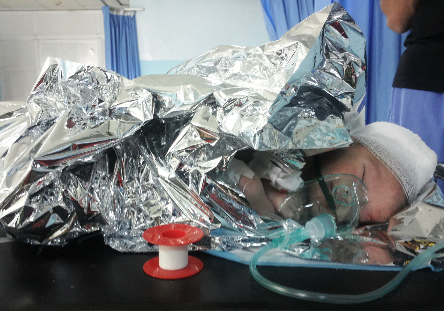 Majed, 27-day old new-born, arrived at MSF surgical project in Ramtha with a head injury due to an explosive barrel bomb. (c)