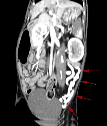 CT-scan