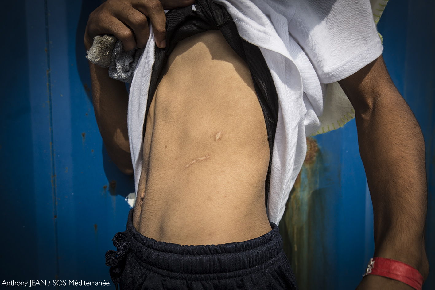 Un hombre muestra una cicatriz que le infligieron en Libia a bordo del Aquarius tras ser rescatado. © Anthony Jean/SOS MEDITERRANEE
