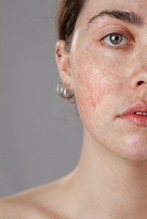 Calm The Redness