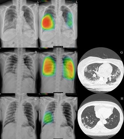▲ Lunit INSIGHT CXR detecting COVID-19 pneumonia in chest x-ray images