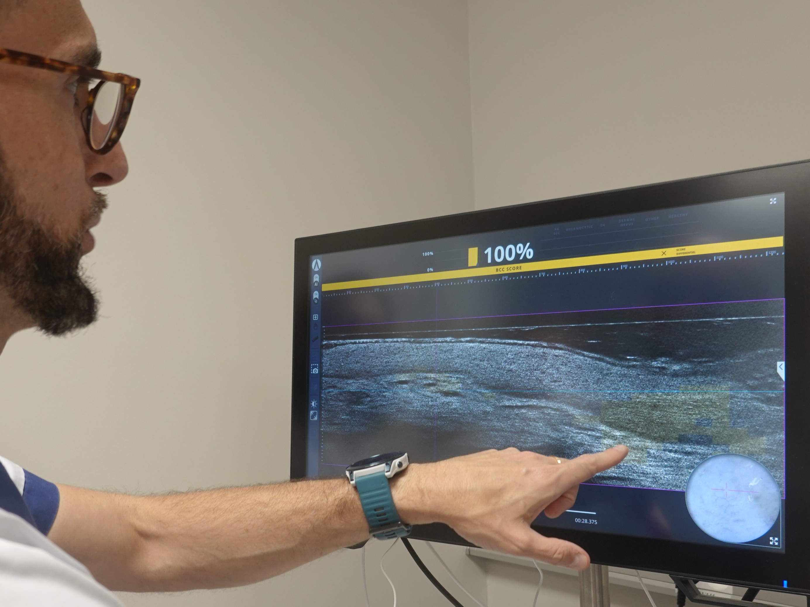 Advanced skin cancer treatment thanks to non-invasive imaging technology