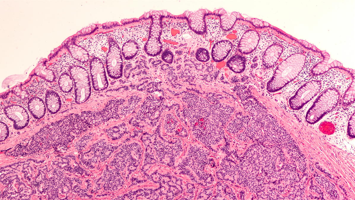 Doorsnede neuro-endocriene tumor