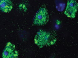 Study reveals key protein’s role in ALS and frontotemporal dementia