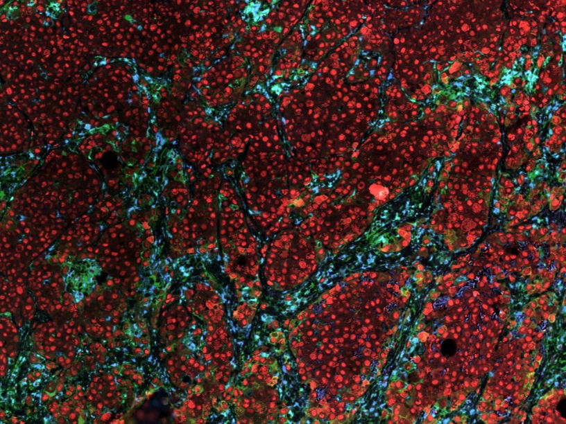 Researchers map cell composition of metastatic melanoma and identify cause of immunotherapy resistance