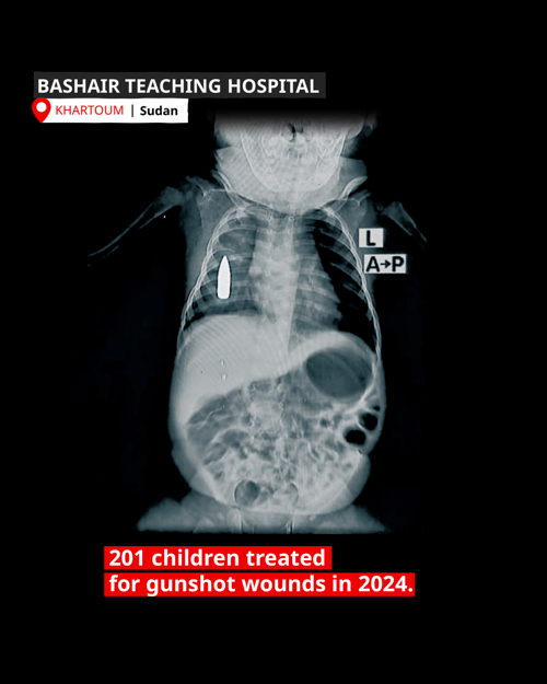 XRay of Baby Riyad. The 18-month-old toddler was struck in the chest by a stray bullet while he was taking a nap in Khartoum. Copyright: MSF