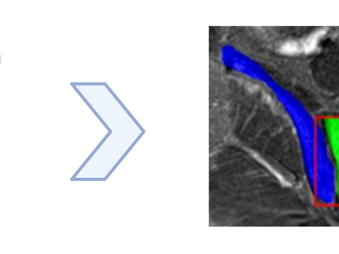 AI assists in arthritis diagnosis based on MRI images 