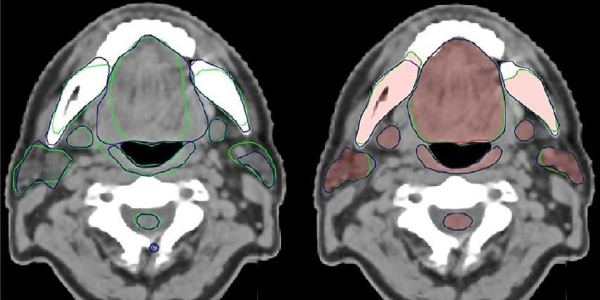 CT-beeld van de hoofd- en halsweefsels. Links: Bij manuele intekening is er veel variatie tussen twee ervaren radiotherapeuten (blauwe en groene lijnen). Rechts: Wanneer ze kunnen gebruikmaken van een voorafgaande automatische intekening door het algoritme (roze), wordt de variatie tussen beide artsen veel kleiner. (Afbeelding uit Van Der Veen et al. 2019, hergebruikt met toestemming van Elsevier.)