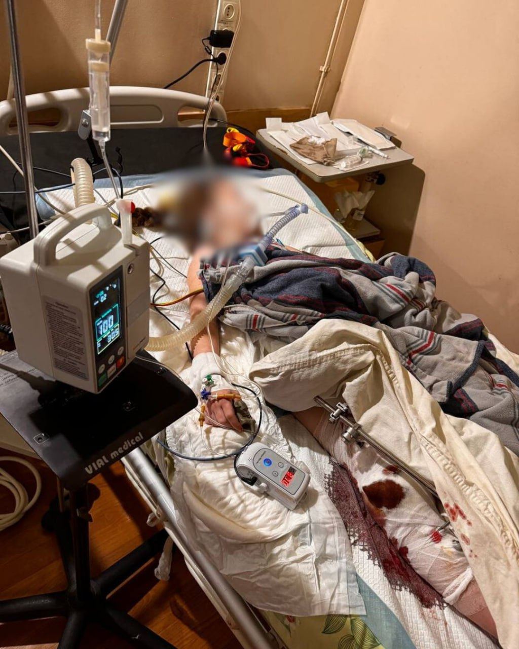 El 4 de abril, las fuerzas rusas atacaron la ciudad de Kryvyi Rih. Entre los casos más graves: una niña de siete años con heridas de metralla, fractura de cadera y shock hemorrágico. Una ambulancia de MSF la trasladó de un hospital local de Kryvyi Rih a un centro especializado de Dnipro. MSF