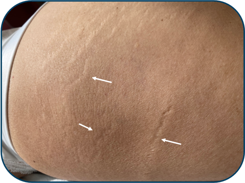 before strech mark