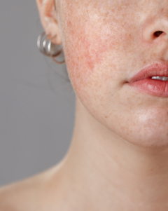 Calm The Redness 2