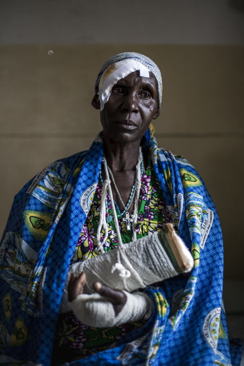 Alphonsime Mojetha (54) recovers in a hospital room on 2 March 2018 in Bunia. After an attack on her village she lost her two children and suffered severe machete lacerations to the back of her head, her arms and her hands. She hid in the bush for two nights before making her way to Bunia to find help. Fighting in Ituri province has left thousands of Congolese displaced and some 100 have lost their lives. PHOTO/JOHN WESSELS