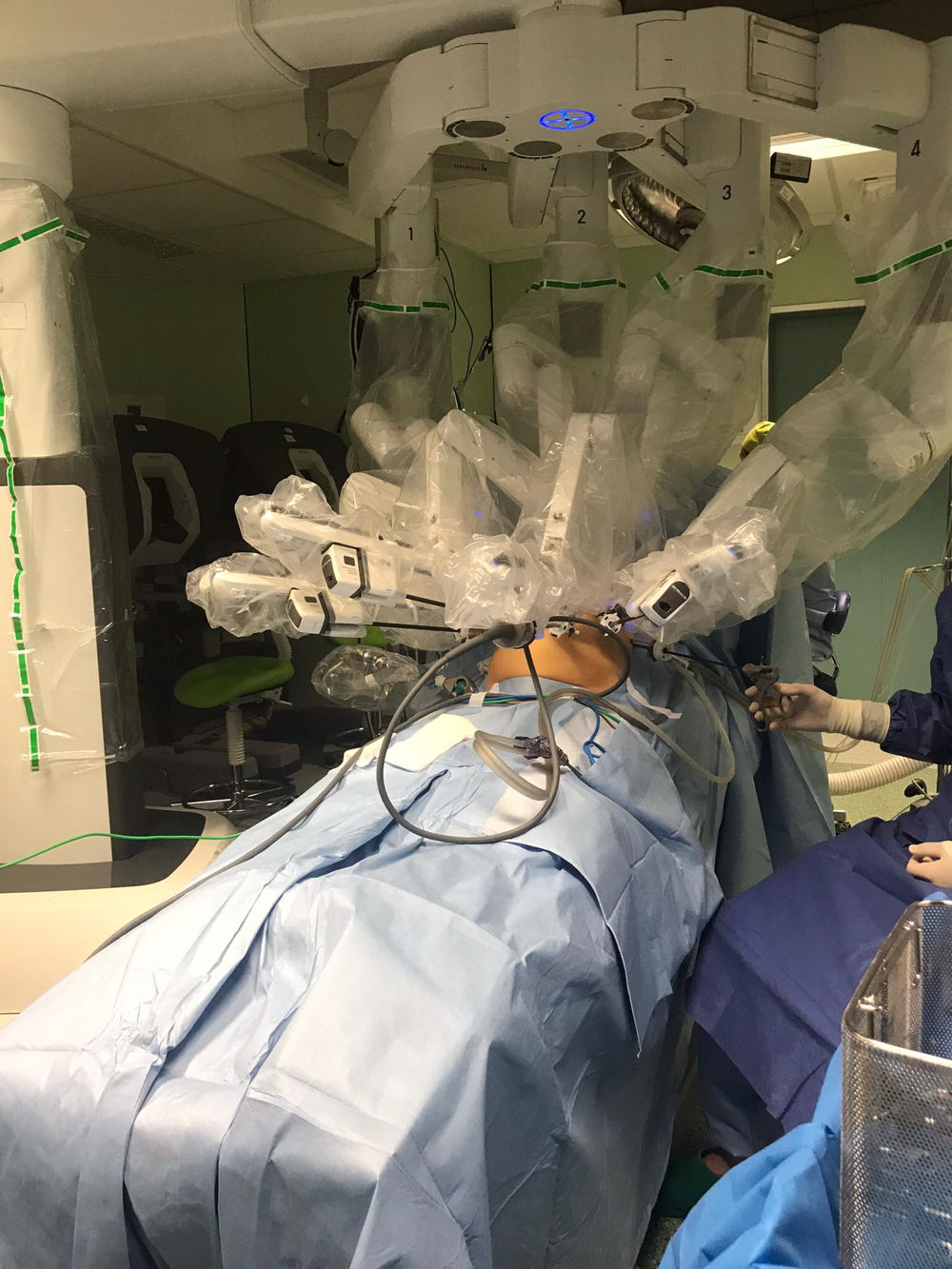 A l’UZ Brussel, le Centre des Maladies Cardio-vasculaires utilise maintenant aussi la chirurgie robotique pour traiter le syndrome de Dunbar