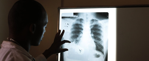 Preview: La tuberculose, en passe de redevenir la maladie infectieuse la plus mortelle, devant le coronavirus