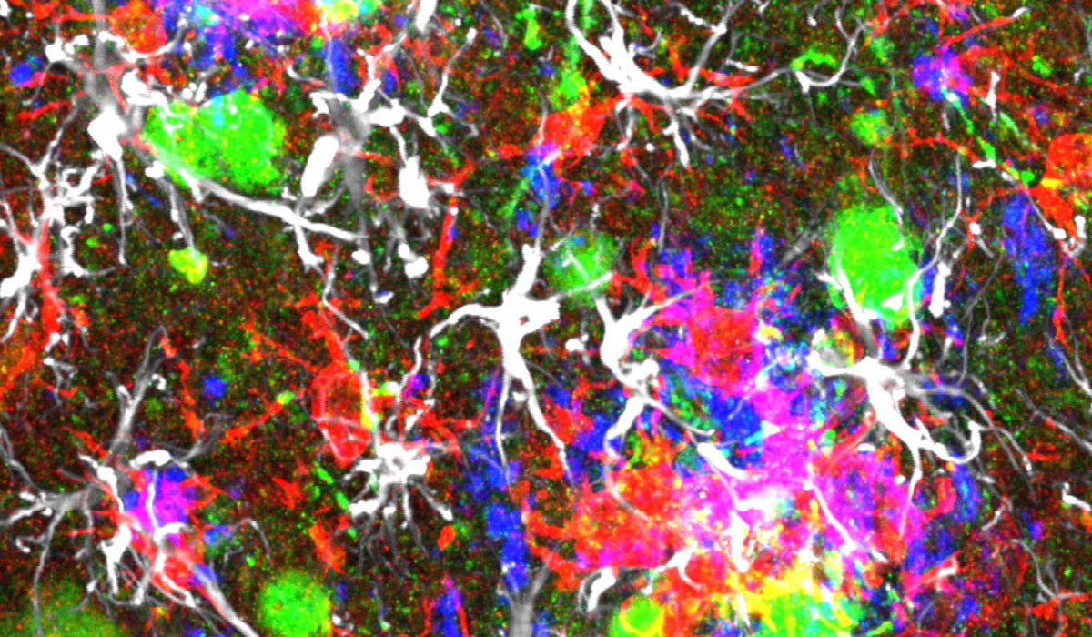 Microscopiebeeld van getransplanteerde menselijke neuronen (groen) en muisneuronen (rood en wit) in een muis met amyloïde plaques (blauw).