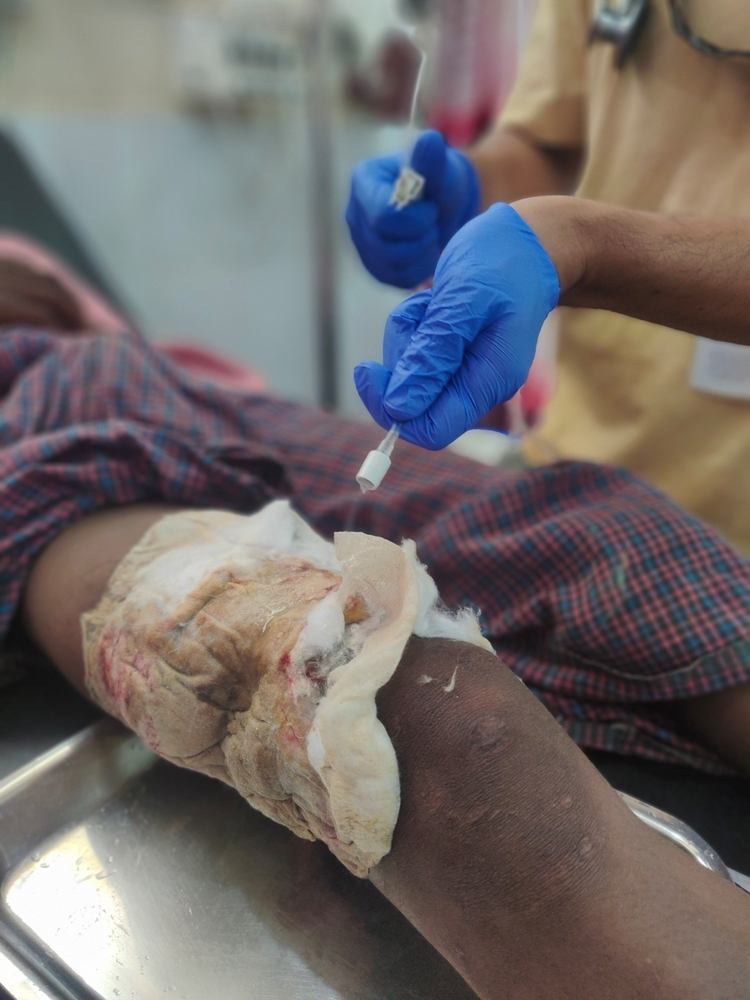 Un adolescente rohinya procedente de Myanmar llegó al hospital de MSF con una grave herida en la pierna. © Mohammad Sazzad Hossain 