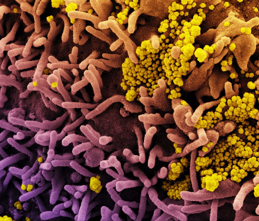 Colorized scanning electron micrograph of a cell (tan) infected with SARS-CoV-2 virus particles (yellow), isolated from a patient sample. Image captured at the NIAID Integrated Research Facility (IRF) in Fort Detrick, Maryland. AKG9036234 ©akg-images / Science Source