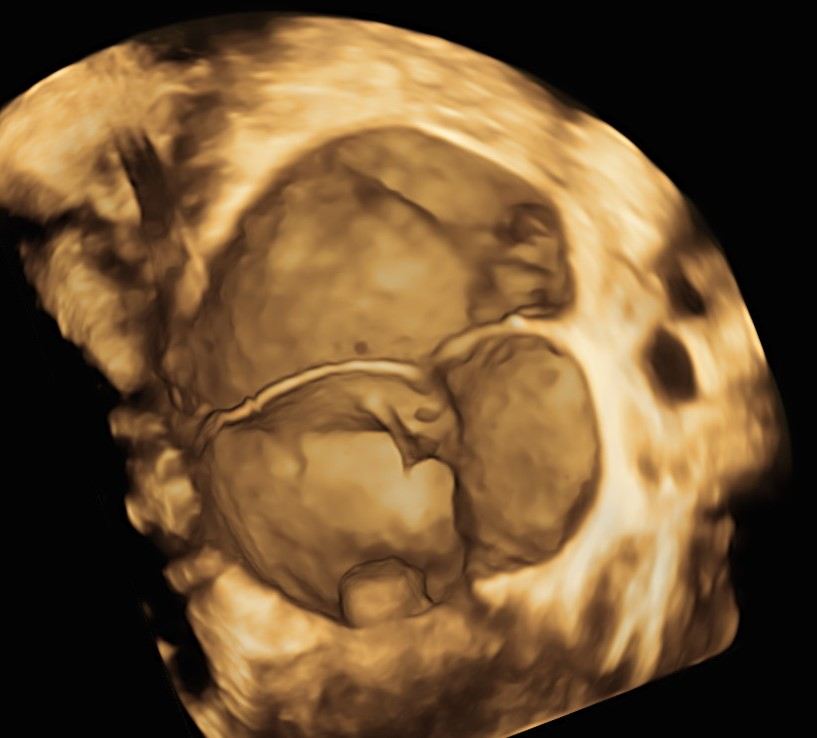 Het model gebruikt visuele kenmerken van de tumor, zoals te zien op dit echografisch 3D-beeld, om een risicoscore te bepalen. In dit geval gaat het om een goedaardige eierstoktumor.