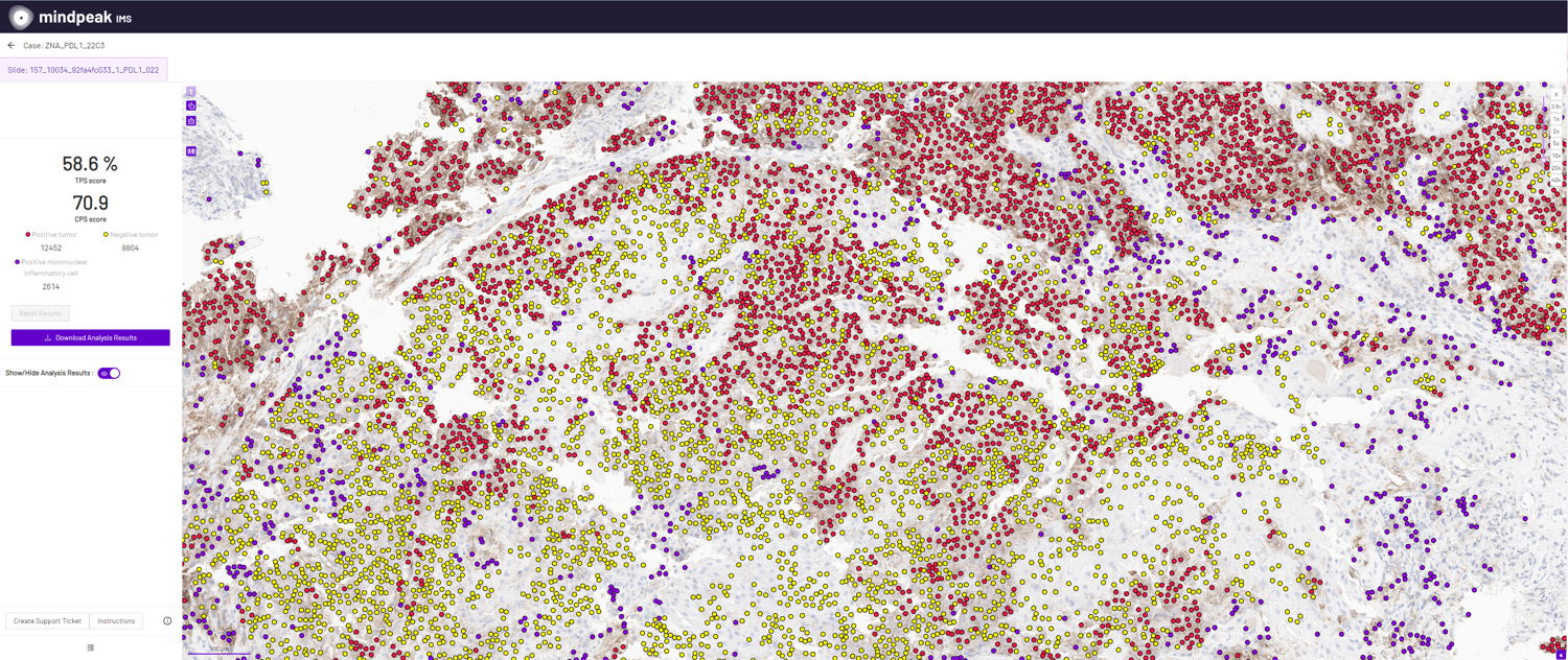 In this scan, AI software from Mindpeak counted and classified the cells. There are tumoral cells that stain for the PD-L1 protein, tumoral cells that do not stain for PD-L1 and inflammatory cells that stain for PD-L1. These 3 parameters are used to fill in a formula (TPS score and CPS score) that helps determine whether a tumour is eligible for immunotherapy. Without the AI, the pathologist has to estimate this by eye.  Translated with www.DeepL.com/Translator (free version)
