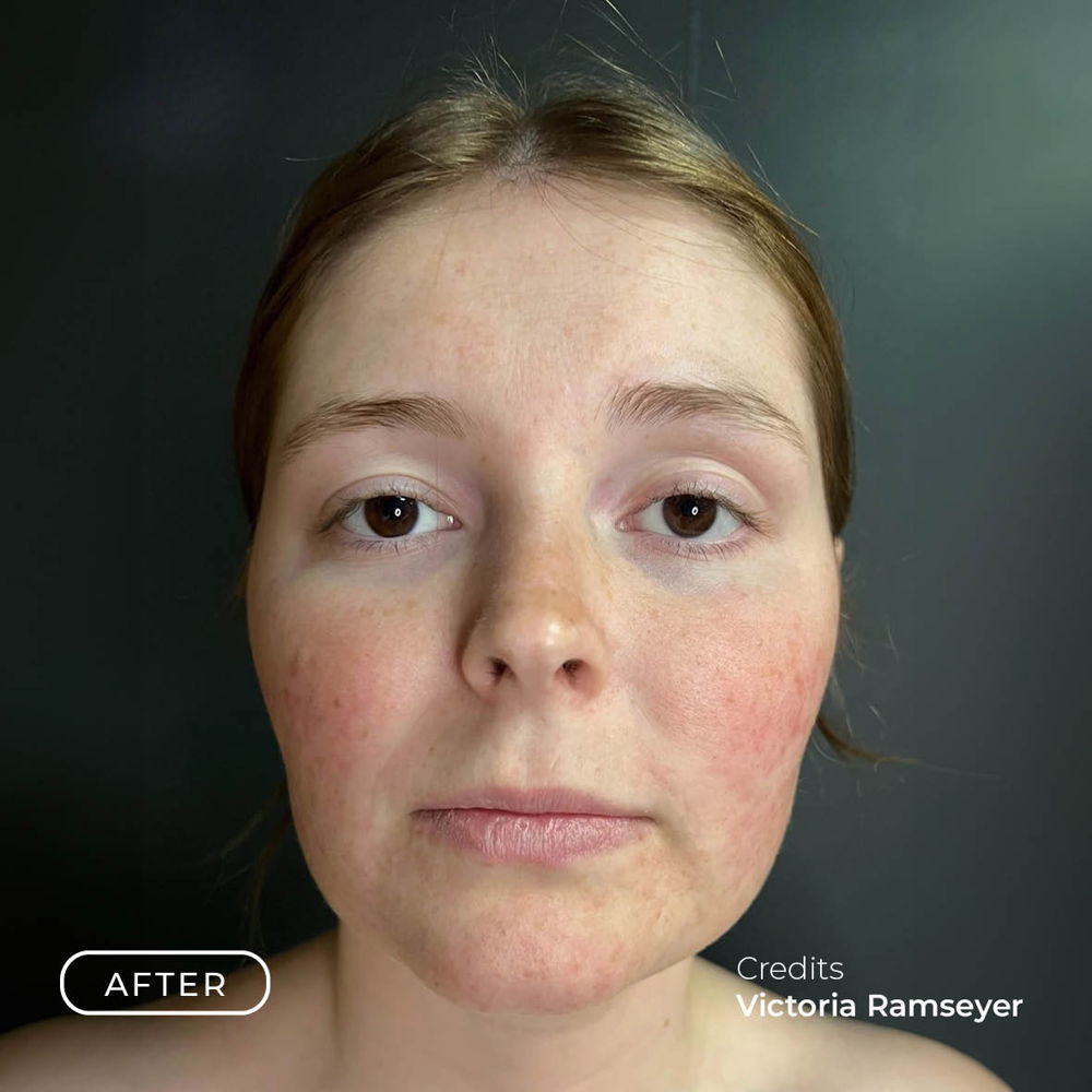 Before After Rosacea2